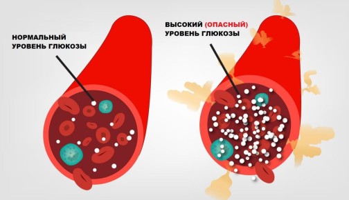 Скрытые признаки предиабета: как понять, что диабет уже рядом